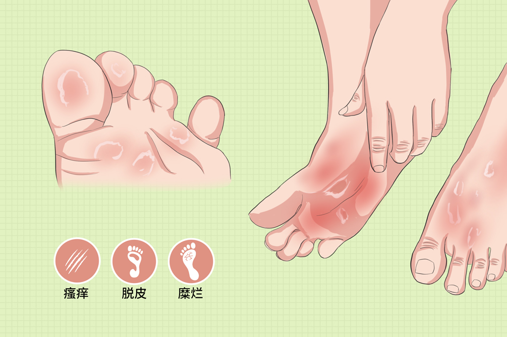 水泡型脚气阴雨天足部防潮(图1) 水泡型脚气阴雨天足部防潮