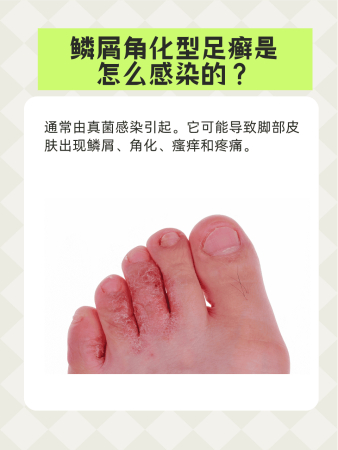 【医学前沿】足癣防治的最新研究成果(图1) 【医学前沿】足癣防治的最新研究成果