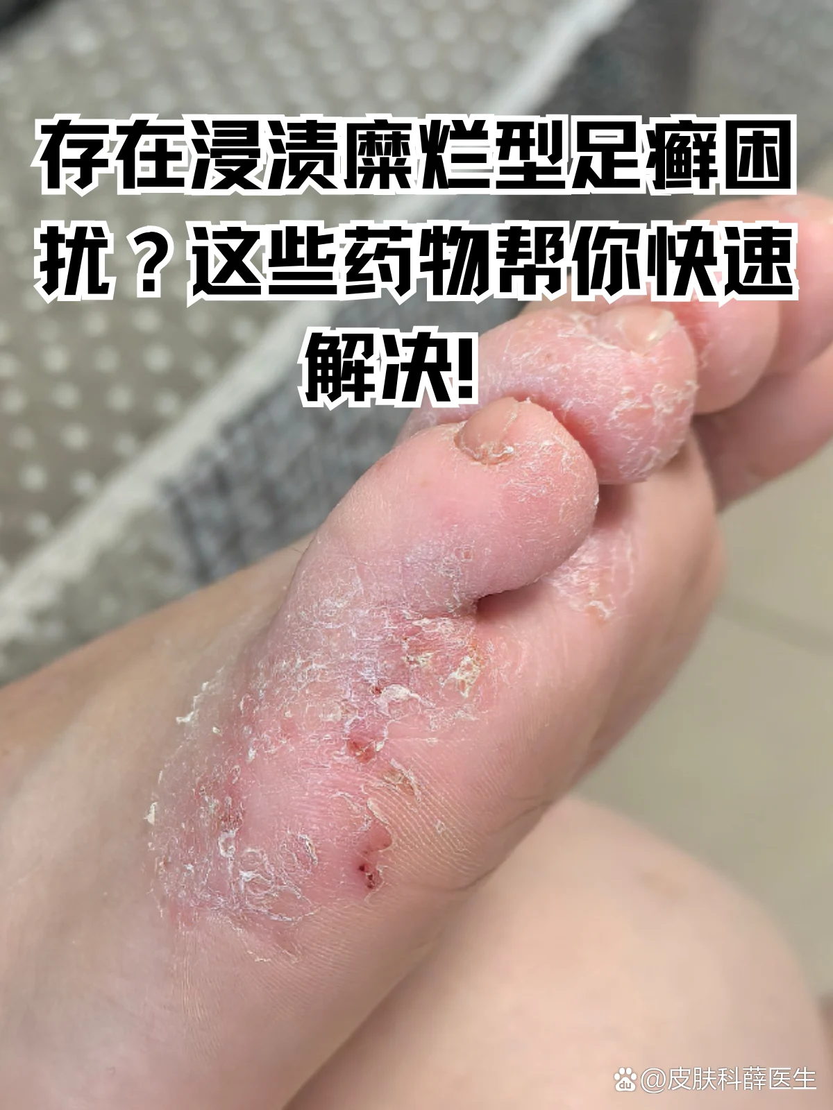 脚部糜烂淋雨後快速恢复