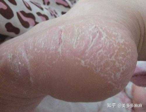 鳞屑型脚气办公久坐防护