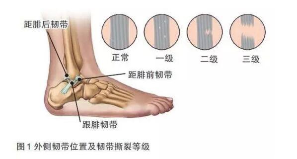 脚部糜烂摩擦后快速恢复(图1) 脚部糜烂摩擦后快速恢复