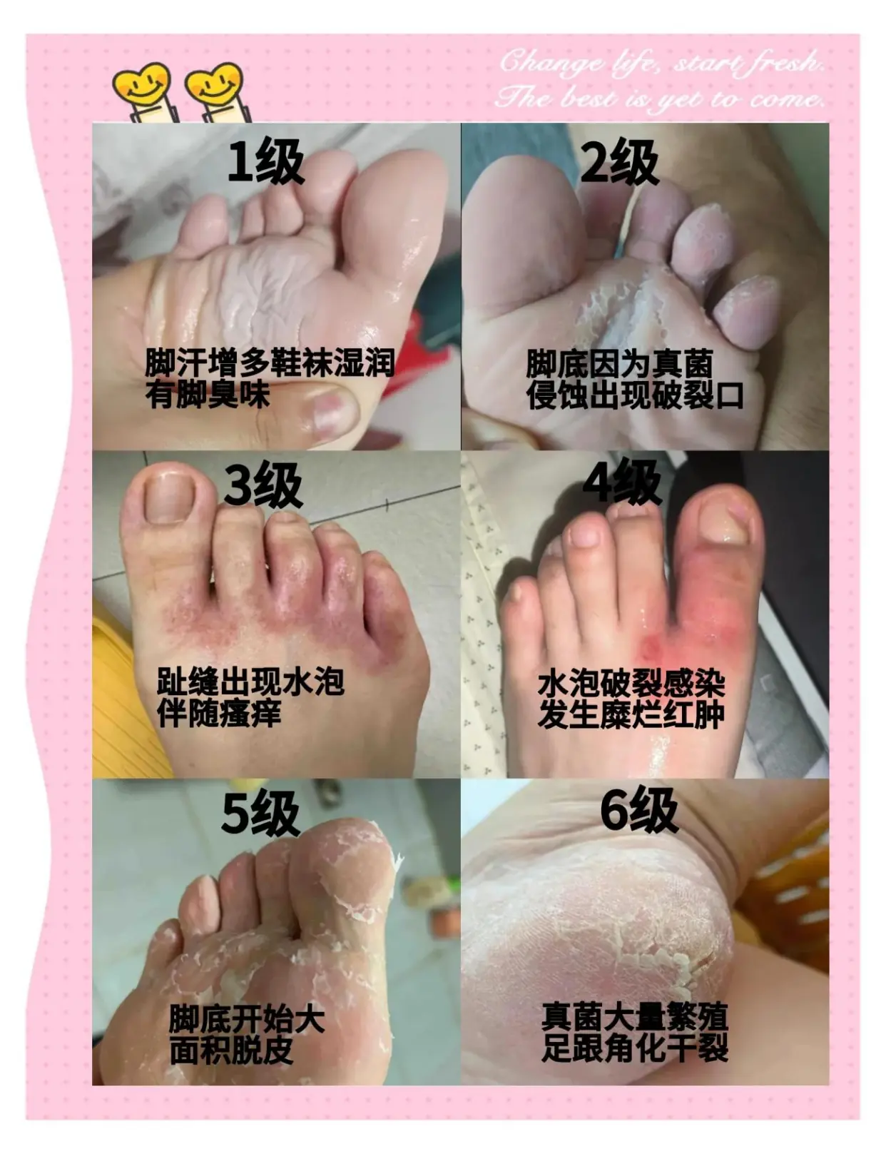 【健康科普】脚气护理患者必读指南(图1) 【健康科普】脚气护理患者必读指南