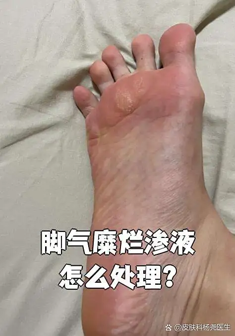 脚部糜烂渗液后快速收敛(图1) 脚部糜烂渗液后快速收敛