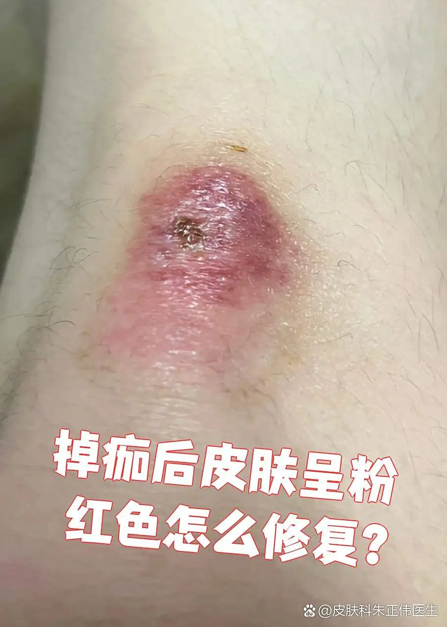 脚部糜烂脱痂后快速修护(图1) 脚部糜烂脱痂后快速修护