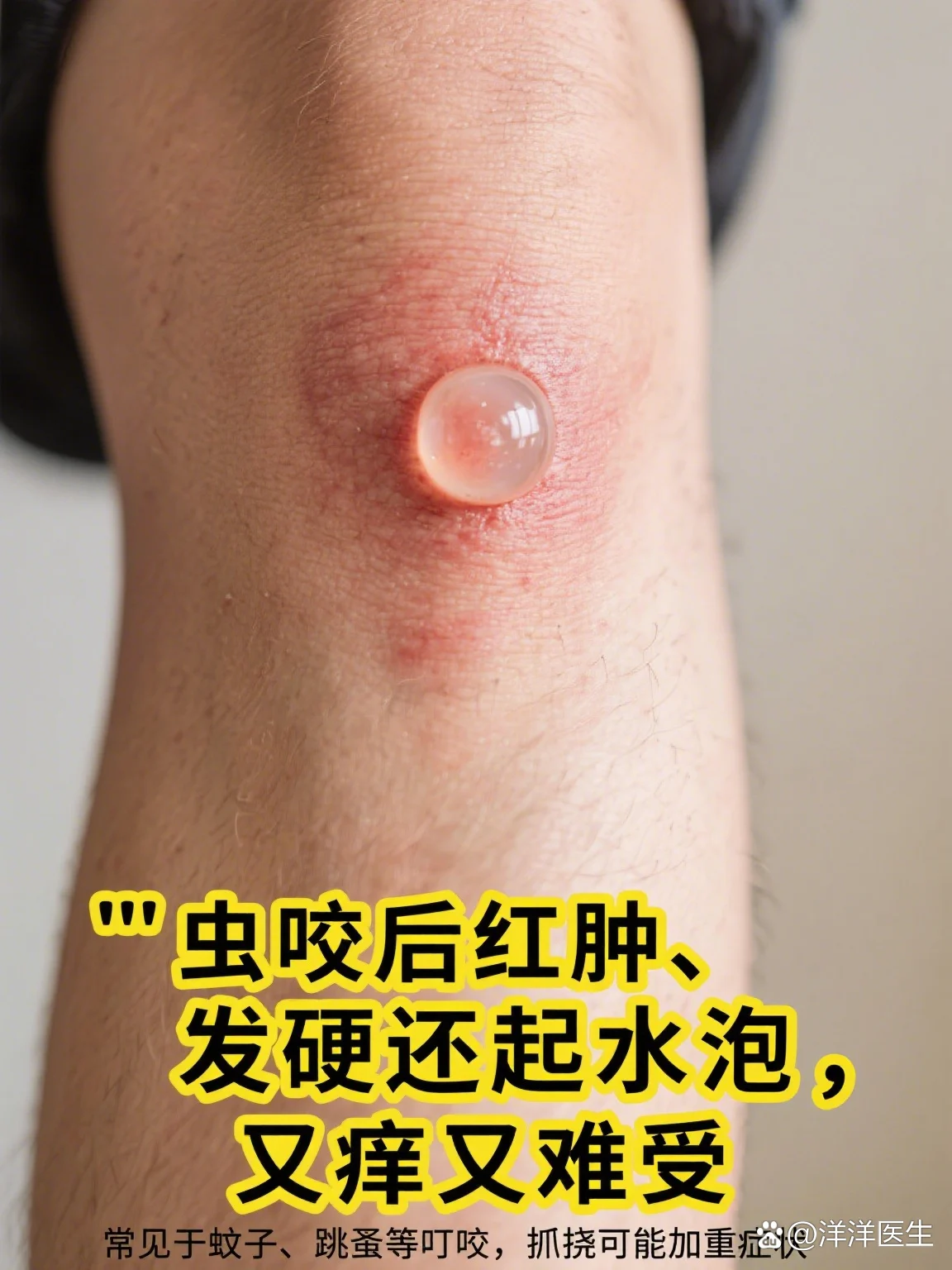 脚部起水泡虫类毒液刺激(图1) 脚部起水泡虫类毒液刺激