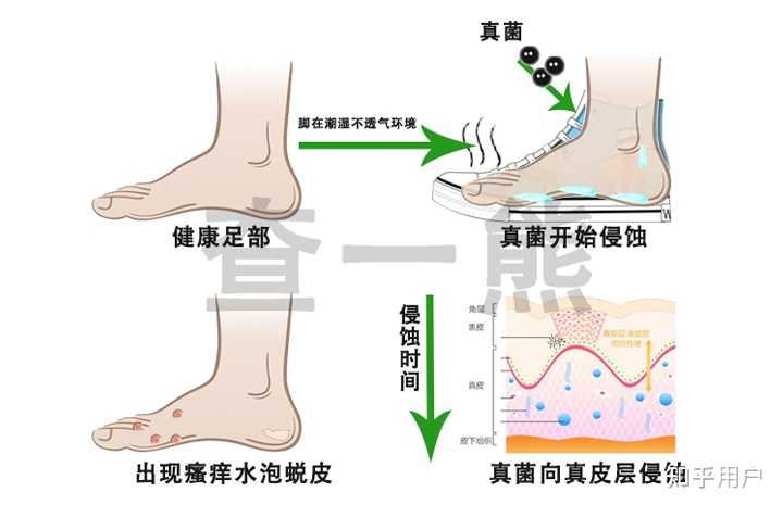 【临床研究】混合型脚气的治疗新突破(图1) 【临床研究】混合型脚气的治疗新突破