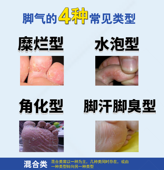【健康问答】关于脚气治疗的常见疑问(图1) 【健康问答】关于脚气治疗的常见疑问