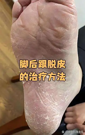 改善摩擦挤压脚脱皮(图1) 改善摩擦挤压脚脱皮
