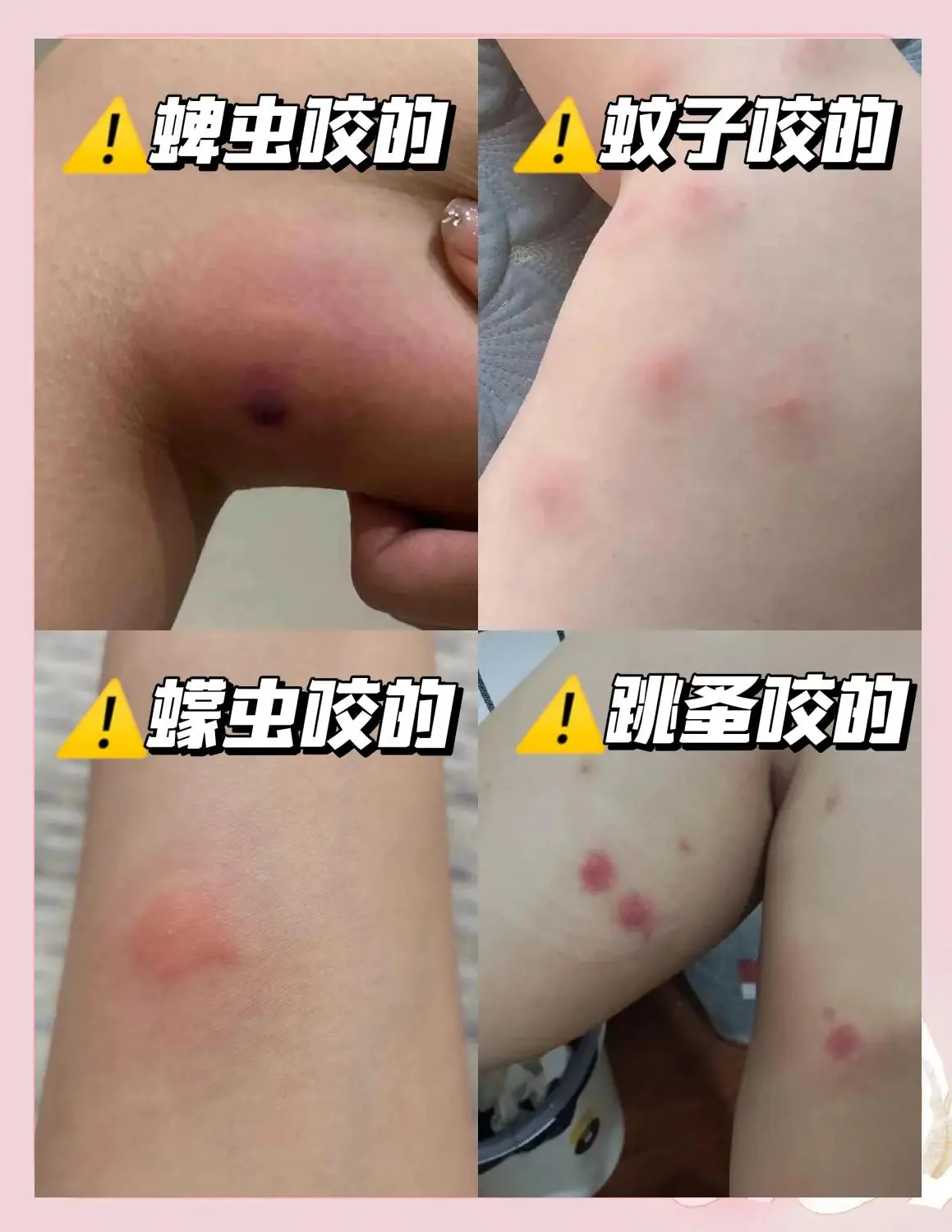 改善蚊虫叮咬后脱皮(图1) 改善蚊虫叮咬后脱皮