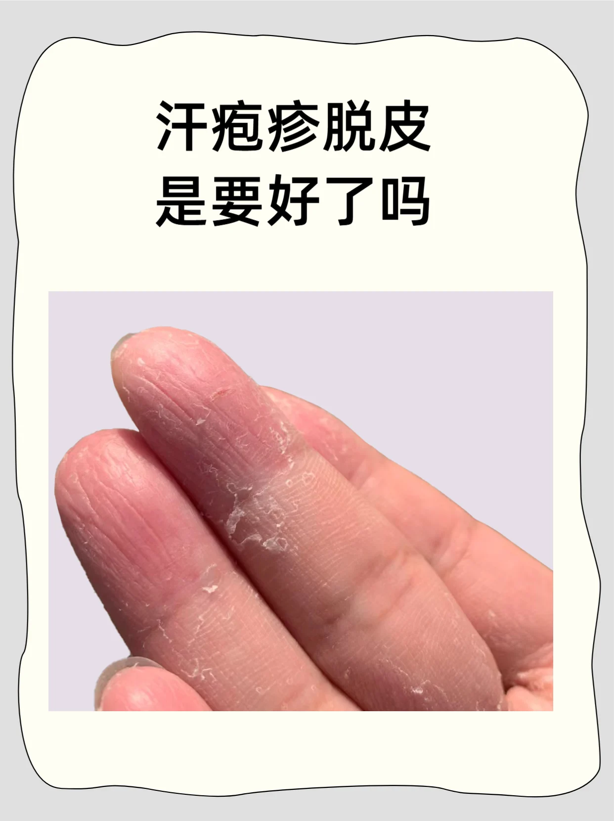 改善汗疹消退后脱皮