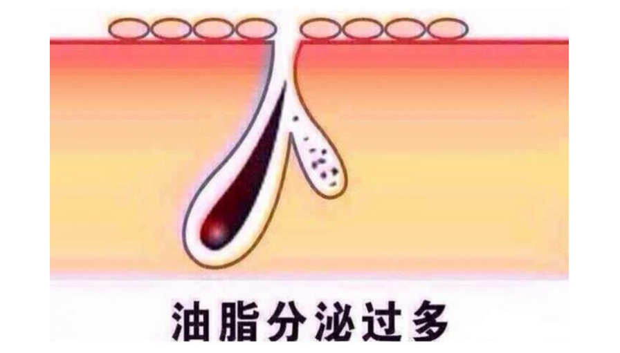 改善脚部油脂分泌旺盛