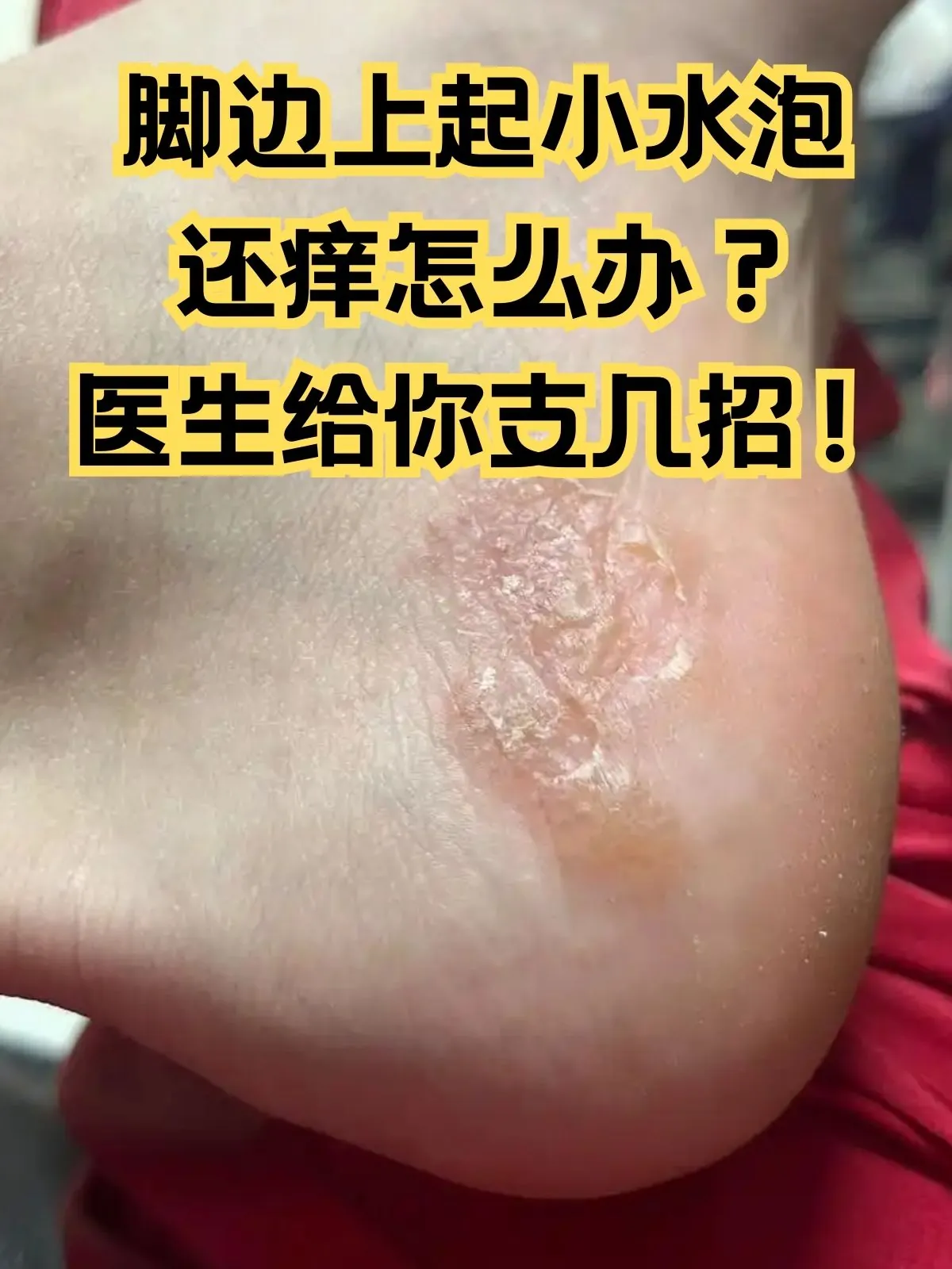 脚部起水泡密集小水泡诱因