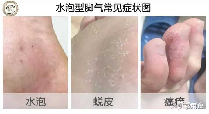 脚部异味足部汗液浸渍(图1) 脚部异味足部汗液浸渍