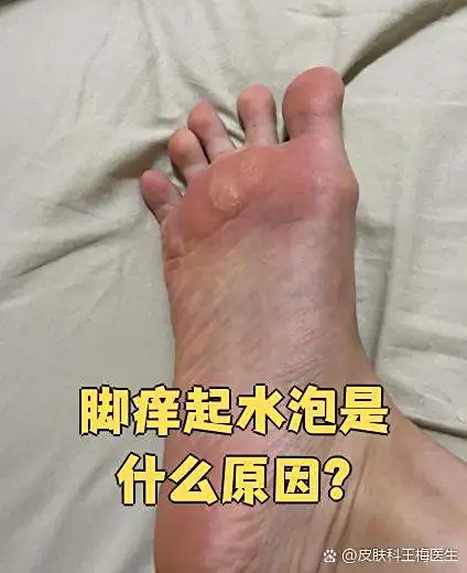 脚部起水泡糜烂面继发水泡