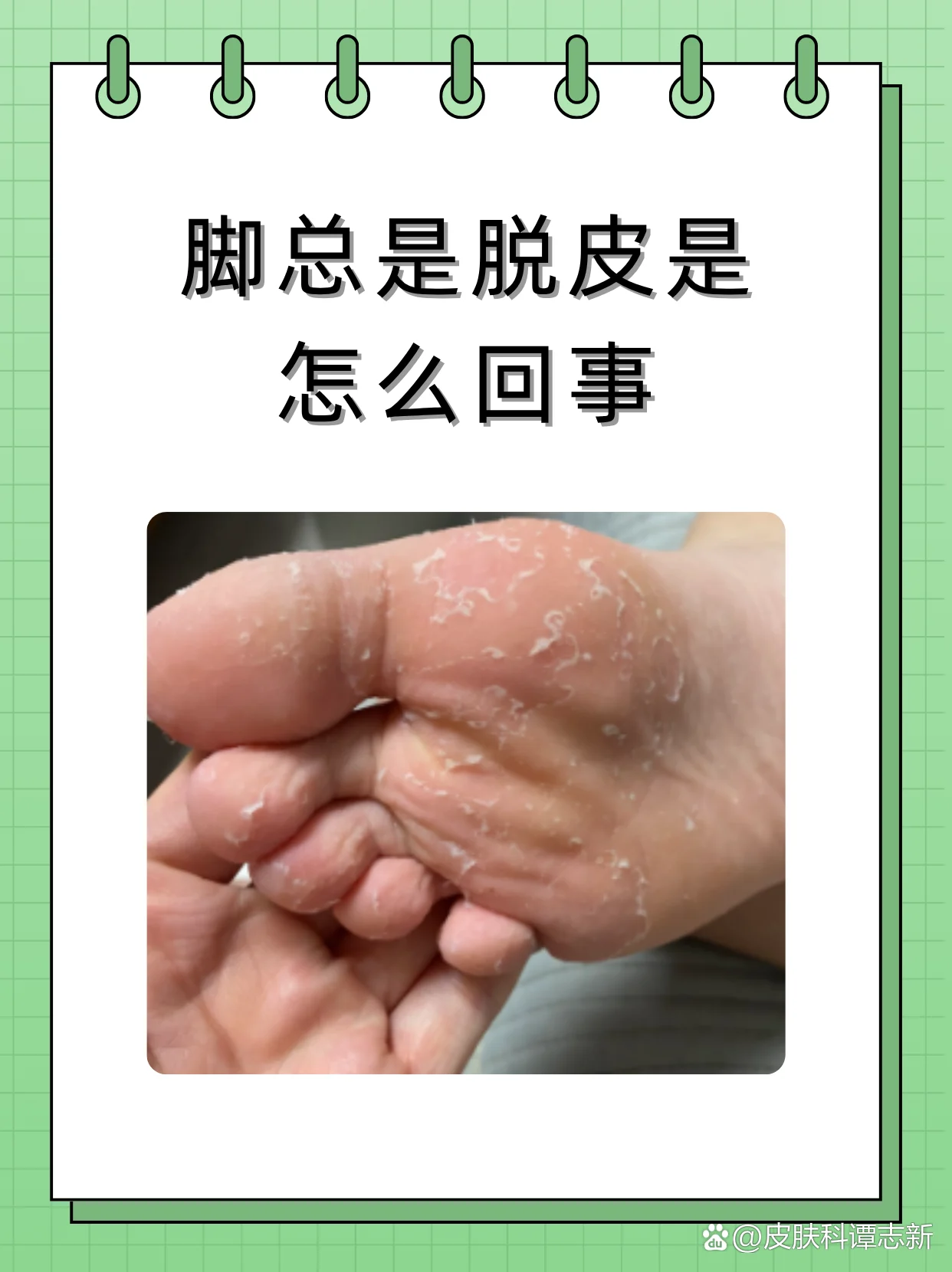 脚部脱皮自我检测方法
