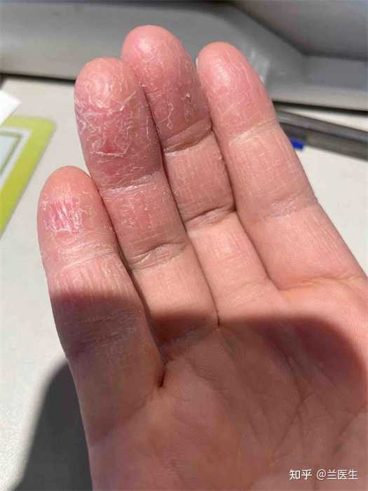 自测干燥脱皮还是真菌脱皮