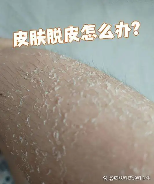 不用药膏温和调理脱皮