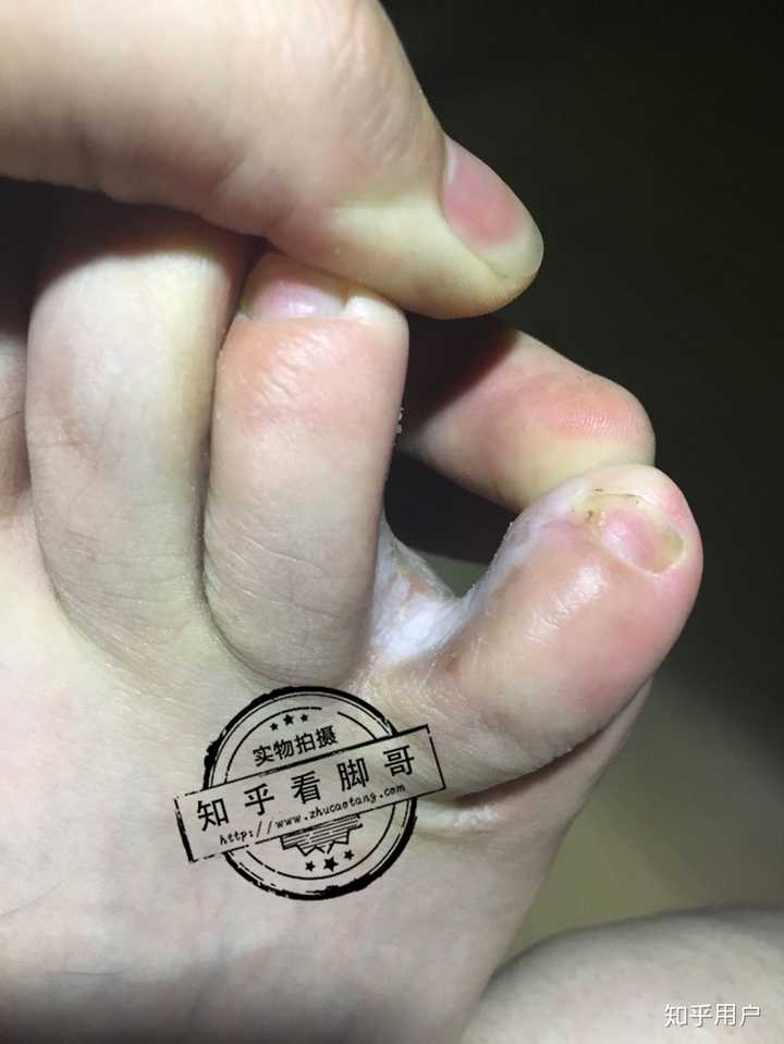 糜烂型脚气户外劳作防护要点(图1) 糜烂型脚气户外劳作防护要点