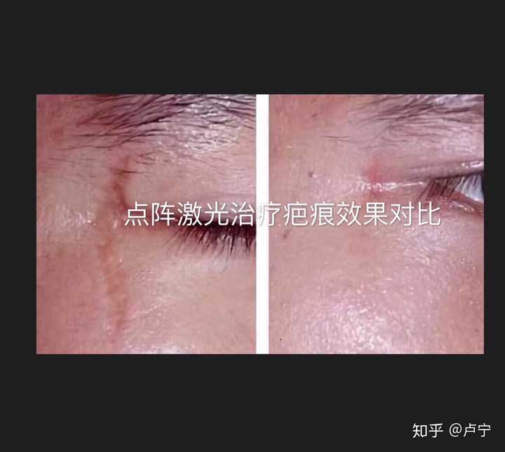 脚部红斑疤痕修复治疗(图1) 脚部红斑疤痕修复治疗