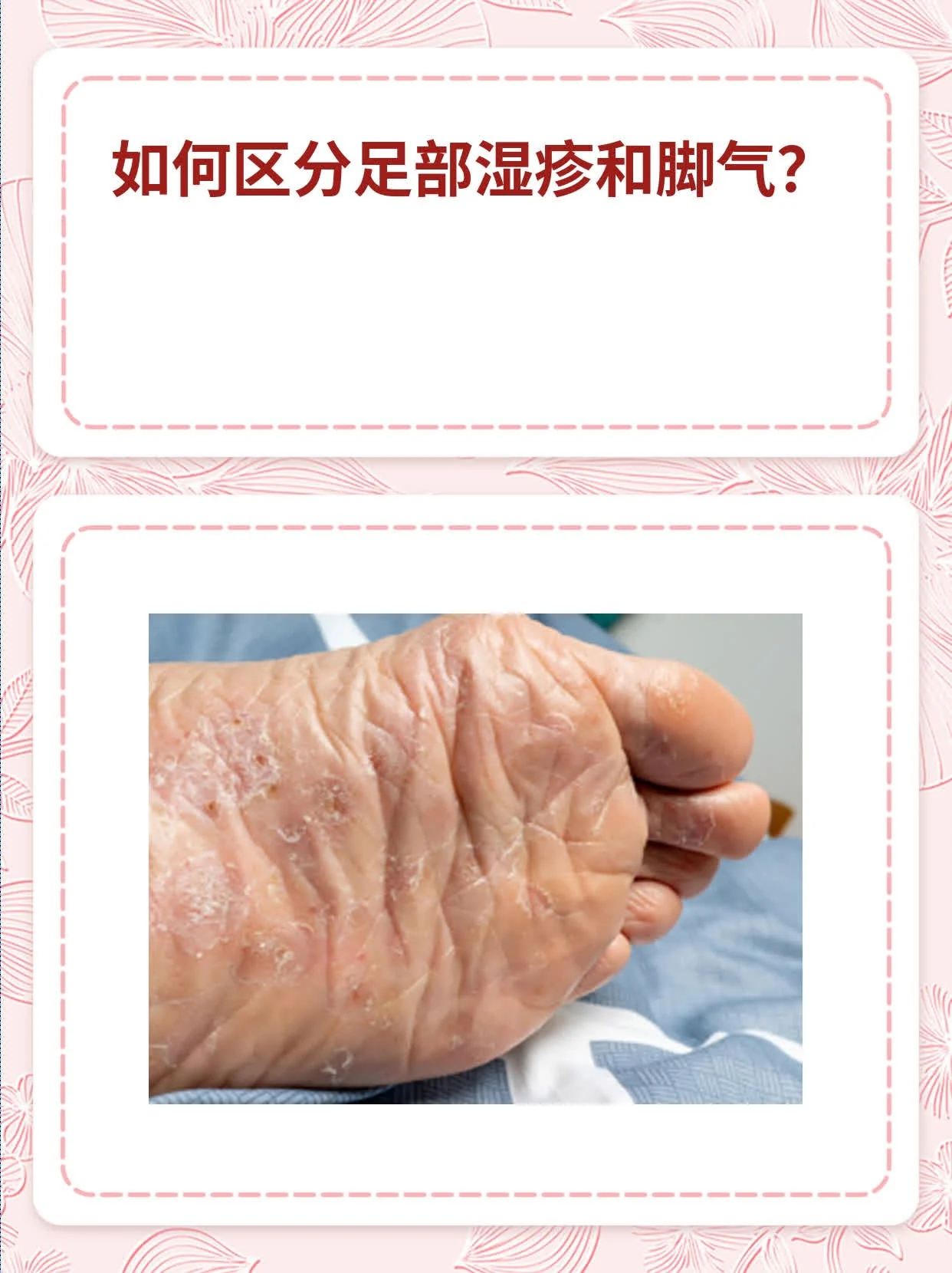 脚部异味盆地湿气滞留足部(图1) 脚部异味盆地湿气滞留足部
