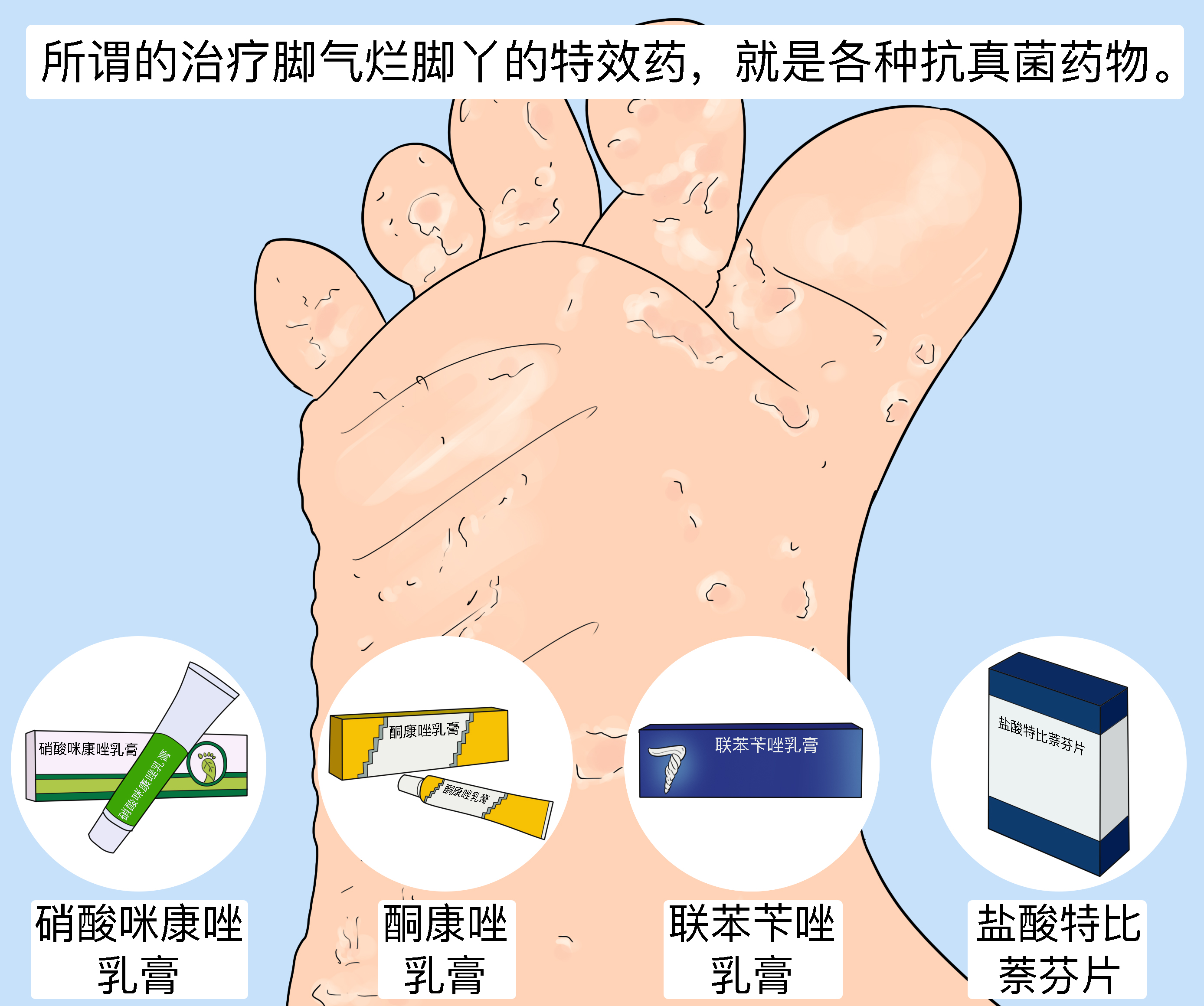 糜烂型脚气外用药物涂抹技巧(图1) 糜烂型脚气外用药物涂抹技巧