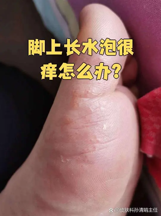 脚部水疱过敏水泡修复(图1) 脚部水疱过敏水泡修复