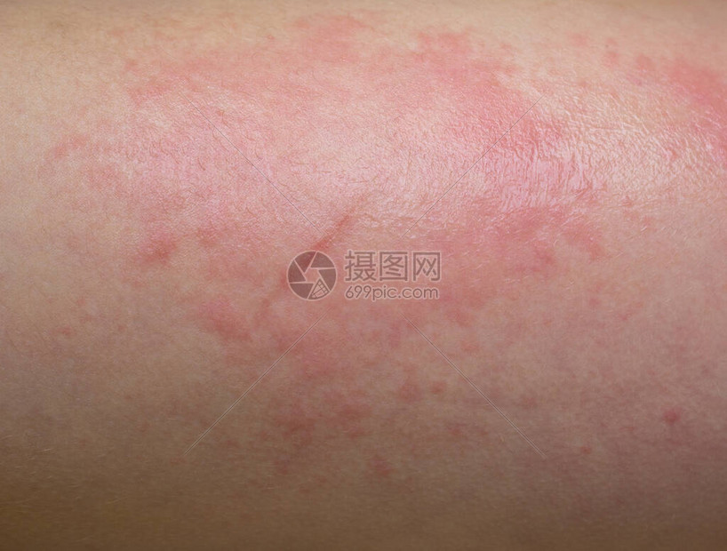 过敏性红斑治疗技巧