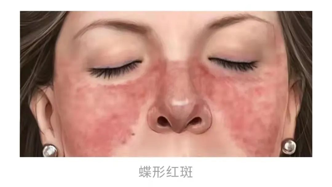 红斑脚气炎症消除方法