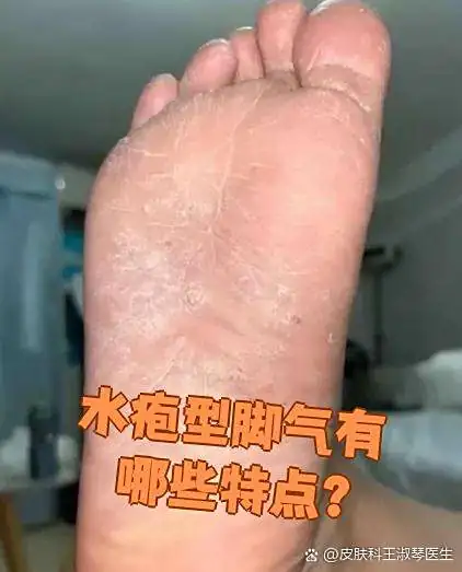 水疱型脚气末梢循环提升(图1) 水疱型脚气末梢循环提升
