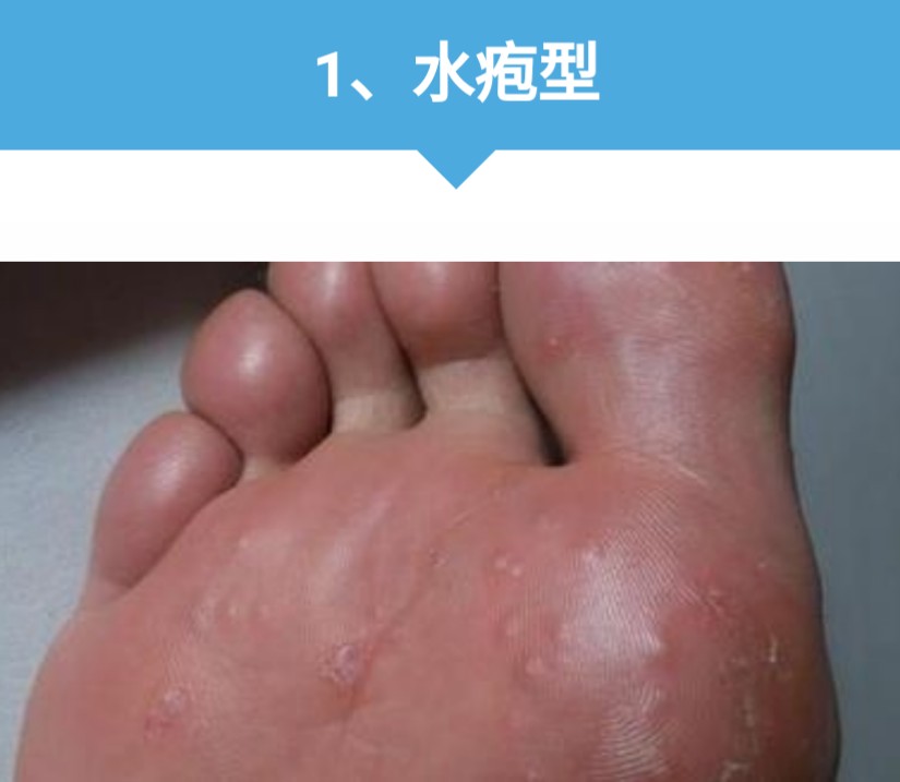 体质偏弱脚部脱屑(图1) 体质偏弱脚部脱屑