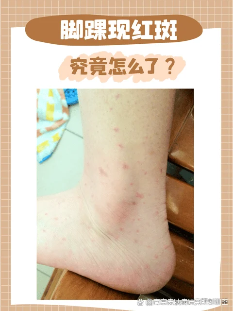 脚部红斑治疗期间清洁要求