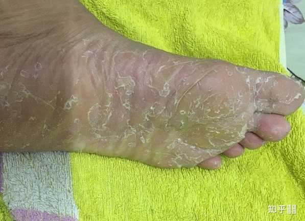 饮水不足脚部脱皮(图1) 饮水不足脚部脱皮