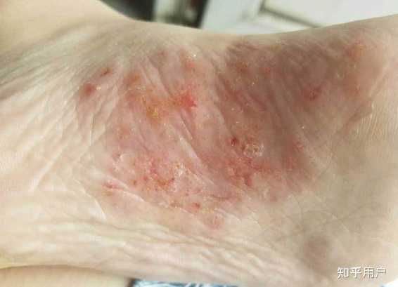 水疱型脚气闷脚鞋子轮换穿