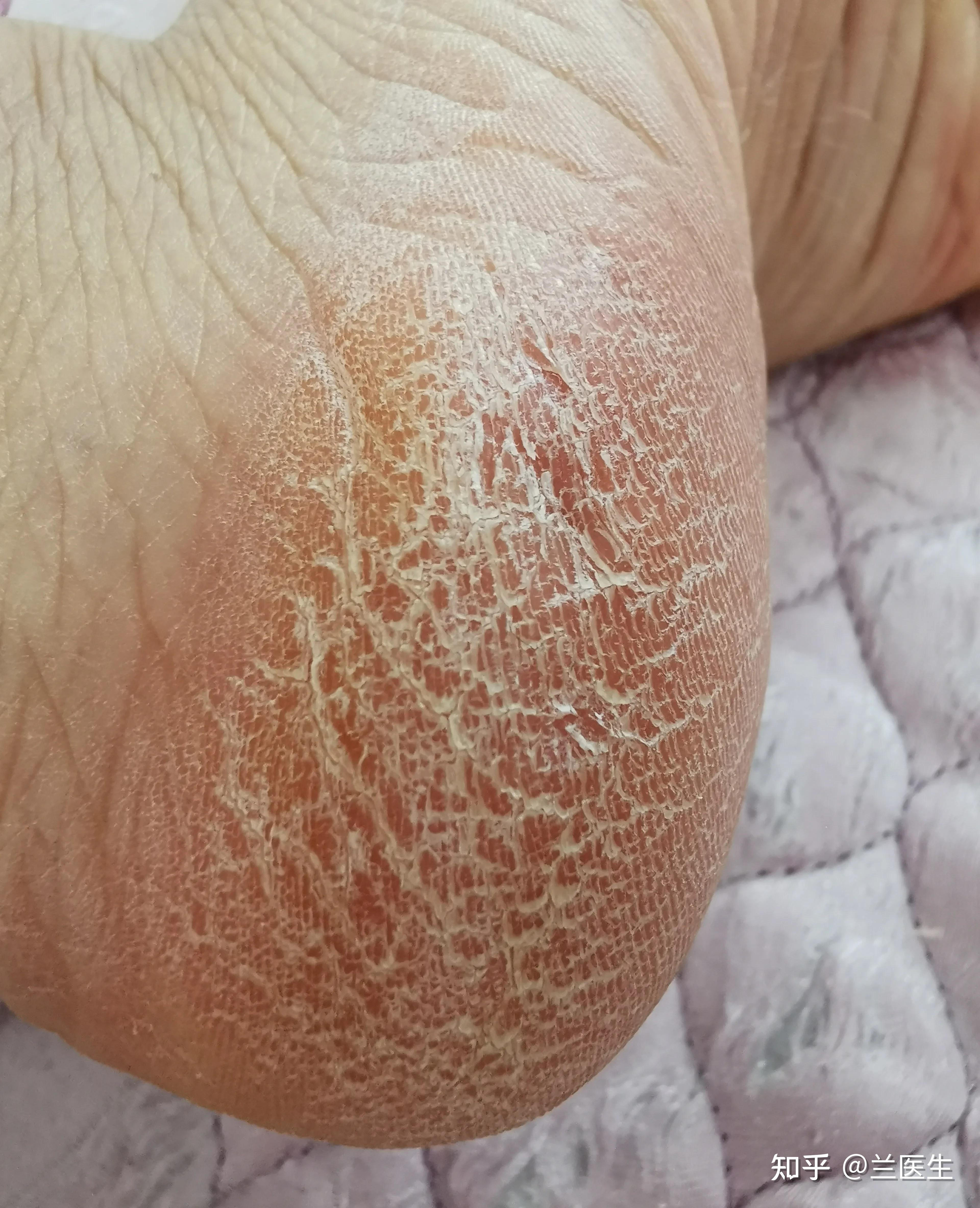 脚部红斑药物刺激成因(图1) 脚部红斑药物刺激成因