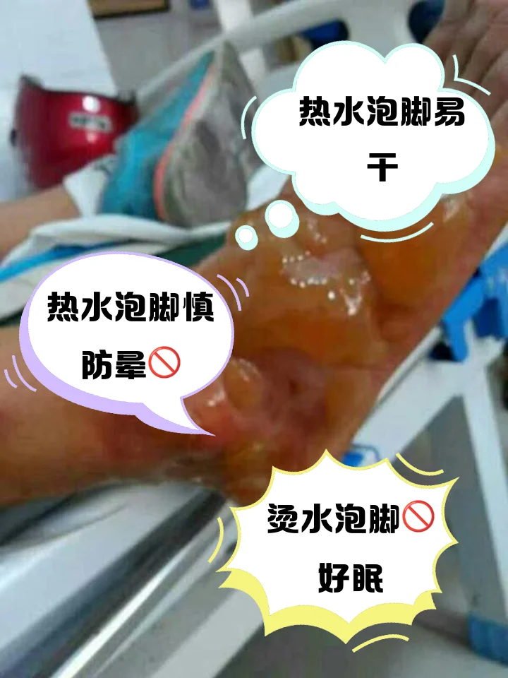 泡脚水过烫损伤脱皮(图1) 泡脚水过烫损伤脱皮