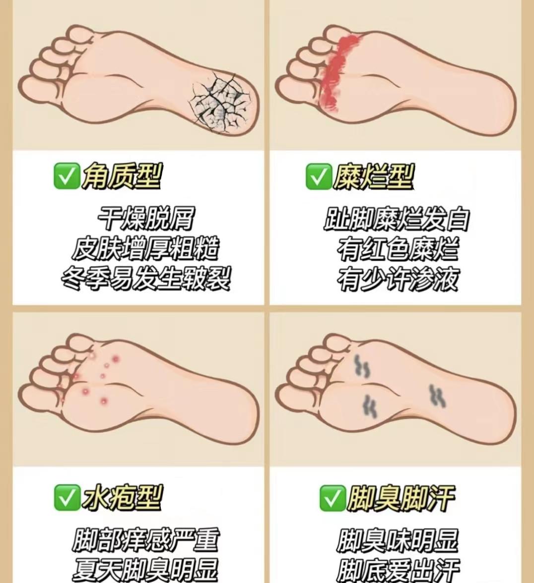脚部糜烂愈后快速巩固方法