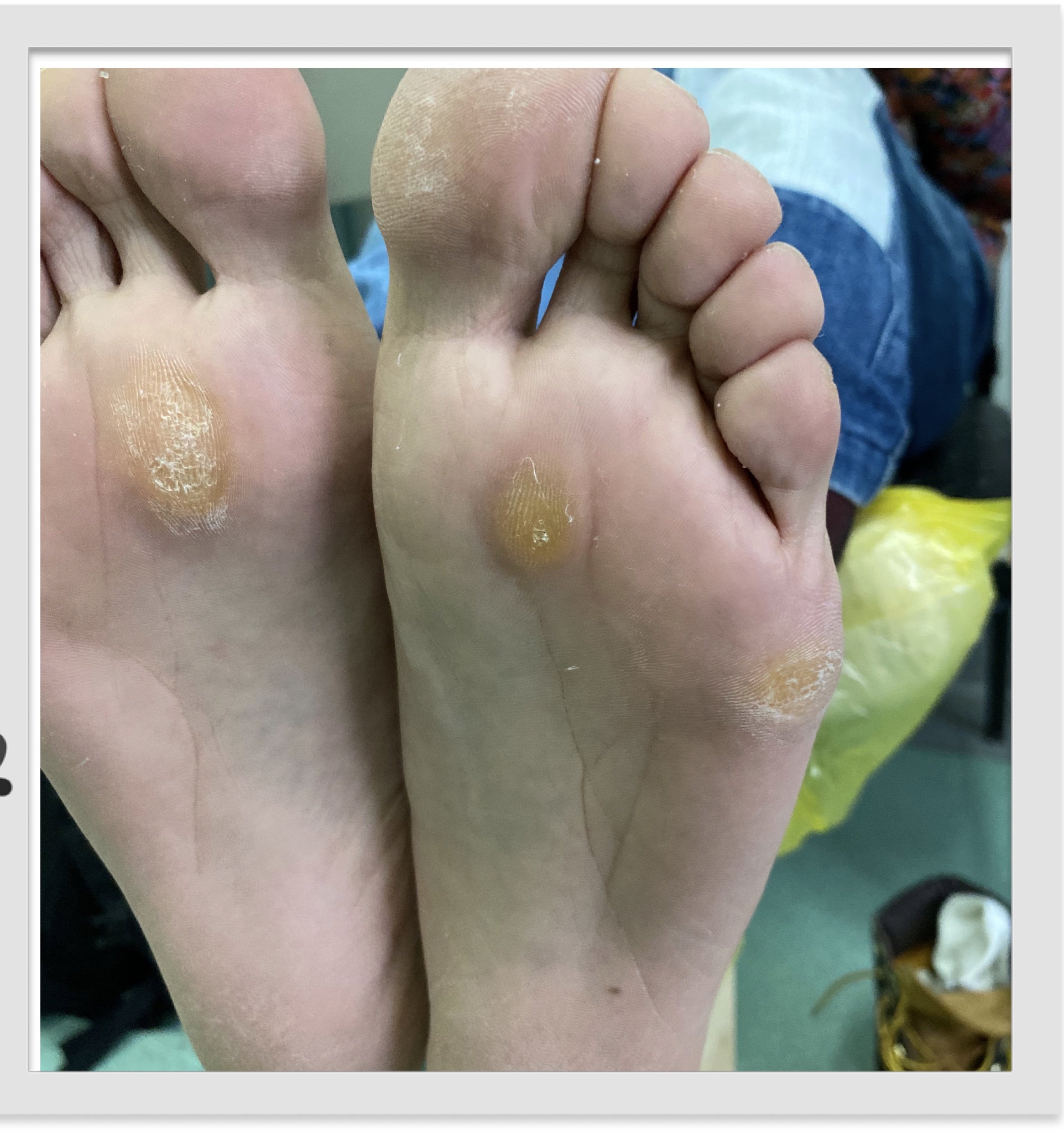 水疱型脚气厚硬老茧软化
