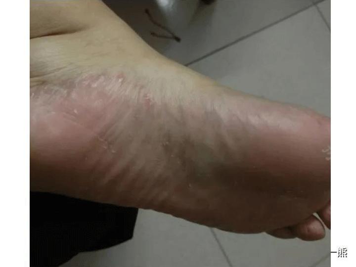 异味型脚气多发人群