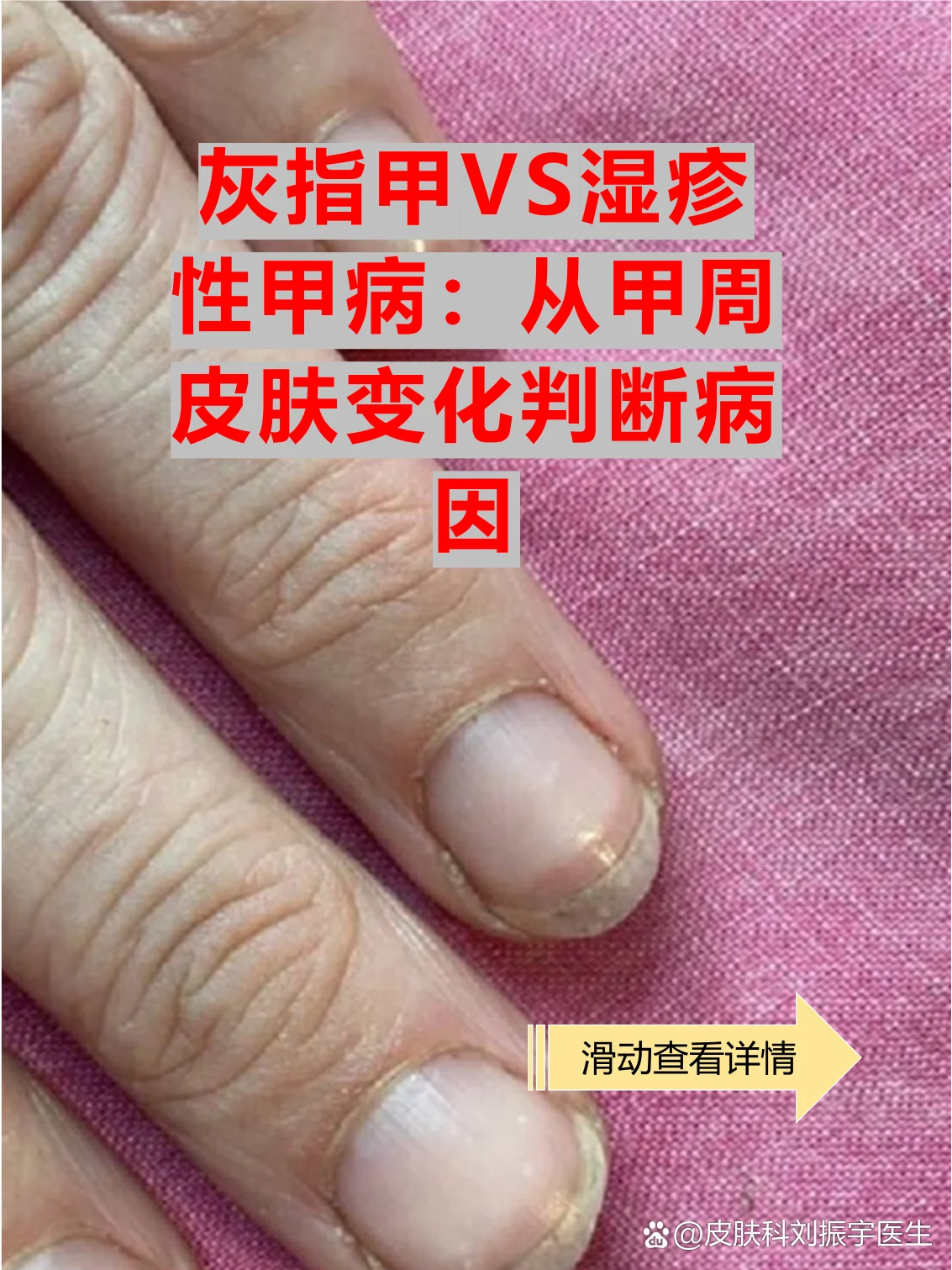 脚部红斑灰指甲伴随红斑诱因