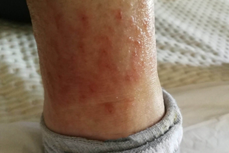 脚部红斑急性炎症诱发(图1) 脚部红斑急性炎症诱发