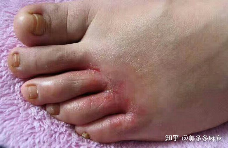 糜烂型脚气日常真菌防控方法(图1) 糜烂型脚气日常真菌防控方法