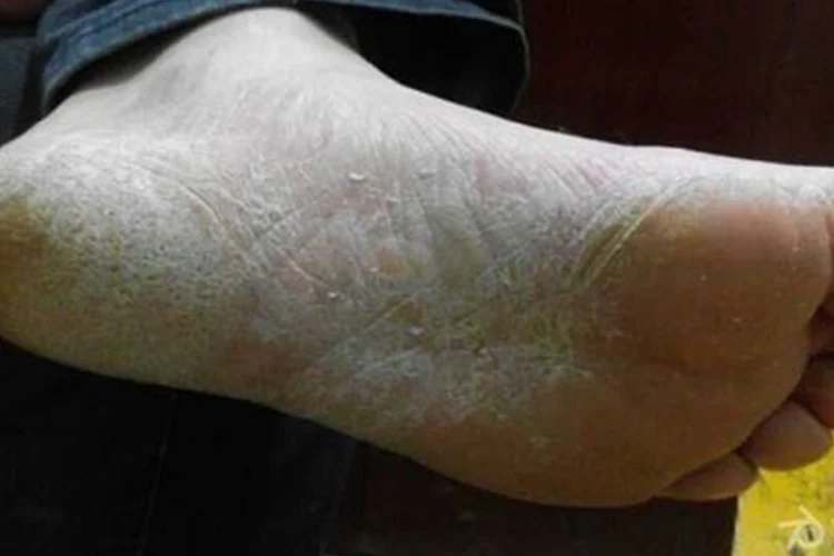 真菌潜伏滋生白屑(图1) 真菌潜伏滋生白屑