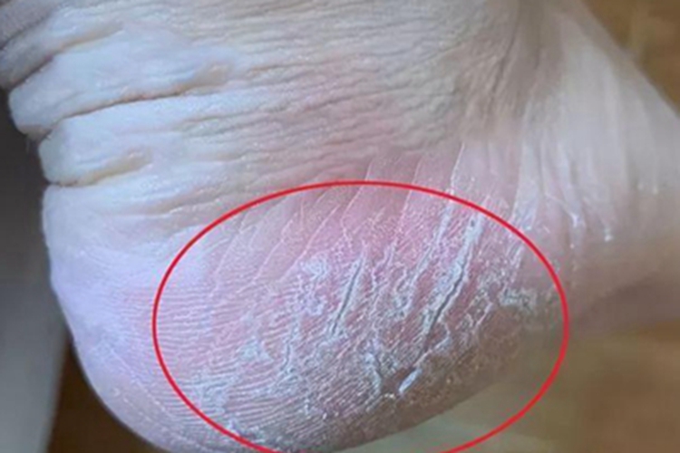 脚部红斑甲状腺疾病累及