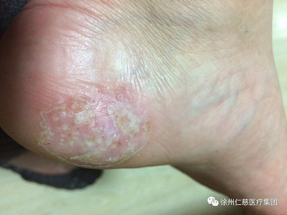 脚部水疱表皮细胞吸水膨胀