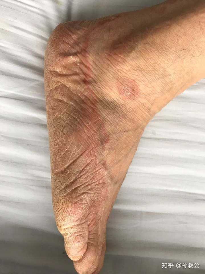 鳞屑脚气向脚背扩散
