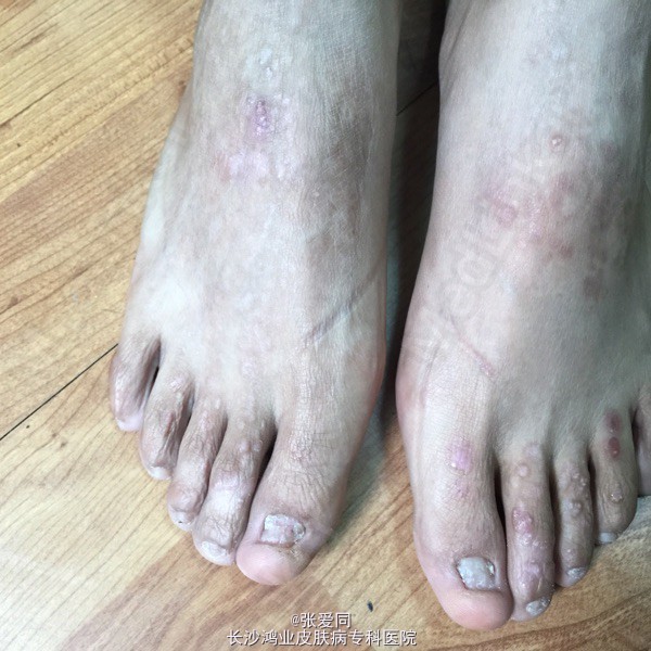 脚部水疱皮肤表层松解脱落