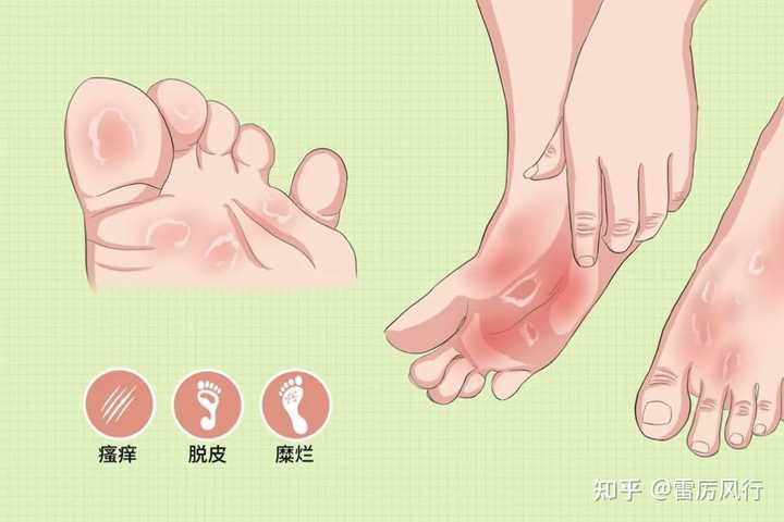 脚部水疱抓挠导致表皮破损(图1) 脚部水疱抓挠导致表皮破损