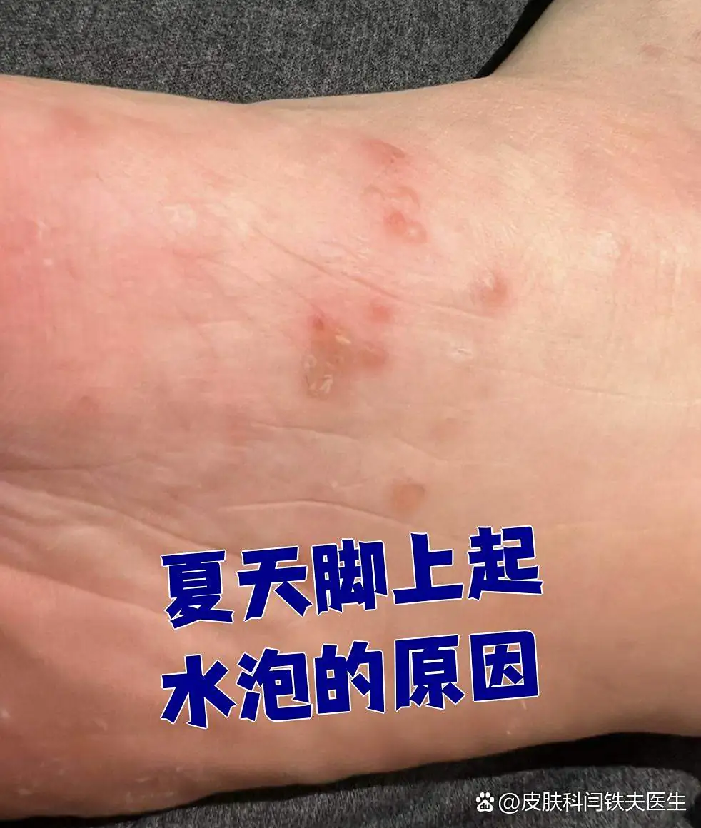脚部水疱表层炎症渗出积液(图1) 脚部水疱表层炎症渗出积液