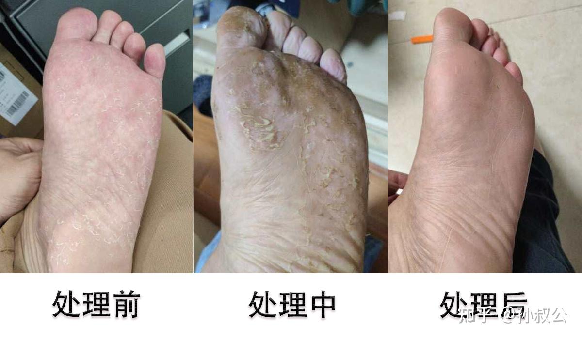 红斑型脚气鞋子过紧危害