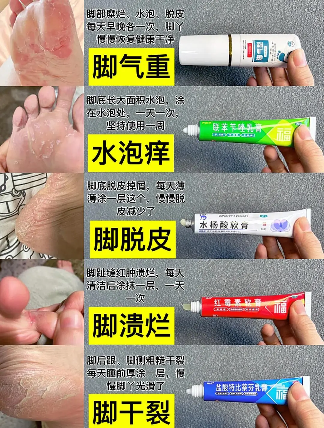糜烂型脚气日常愈后巩固保养方法(图1) 糜烂型脚气日常愈后巩固保养方法
